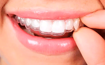 Invisalign Treatment for Teens