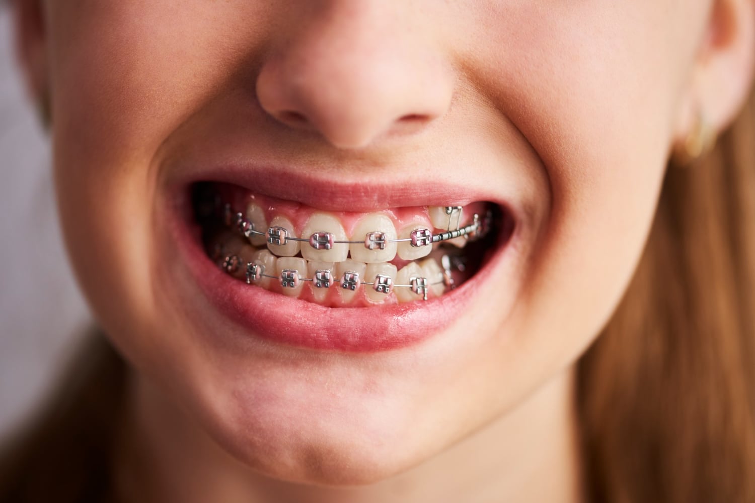 Dental Braces Treatment