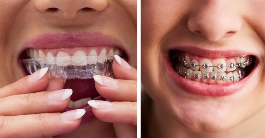 Orthodontic Treatment